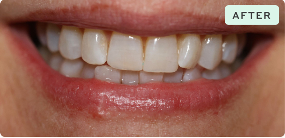 Dental Result After