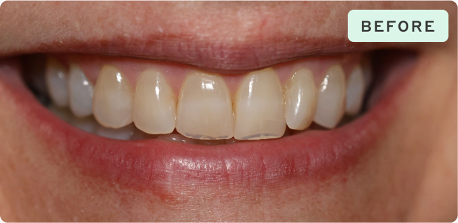 Dental Result Before