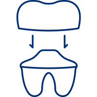 Dental Crowns And Bridges